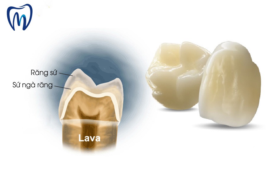 làm răng sứ lava 3M
