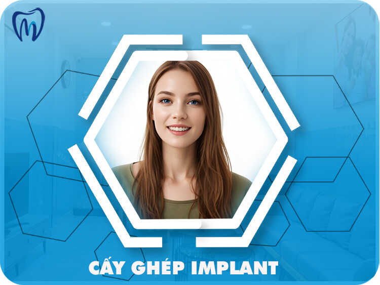 CẤY GHÉP IMPLANT