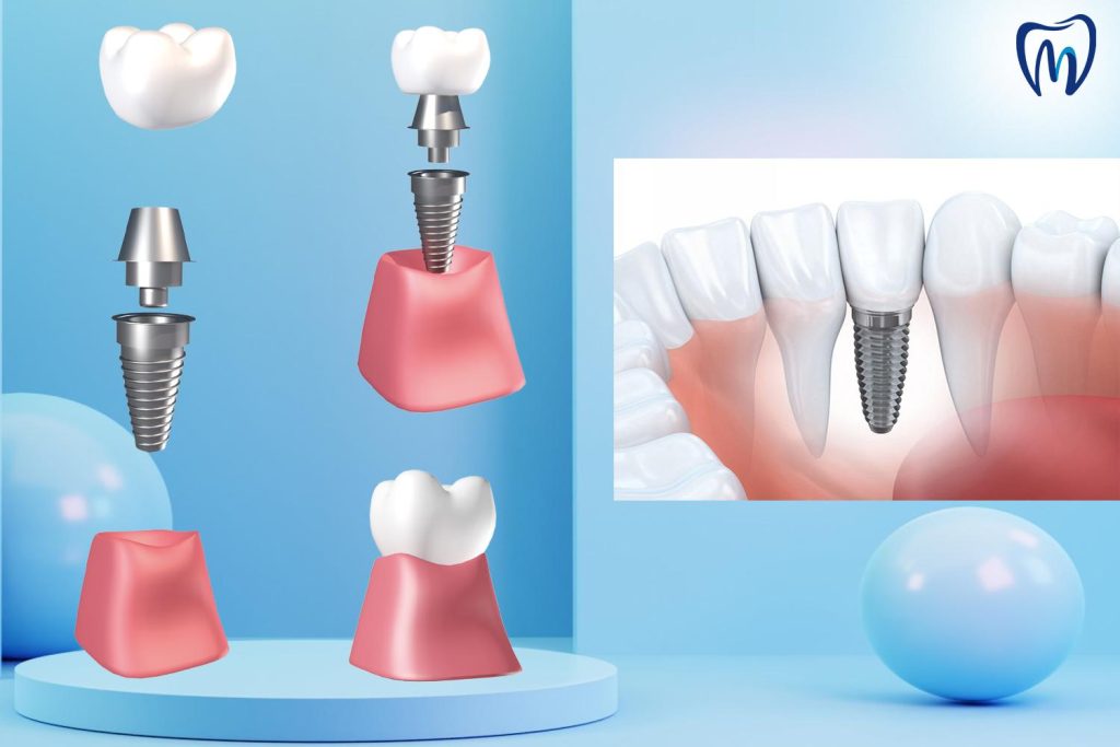 cắm trụ implant