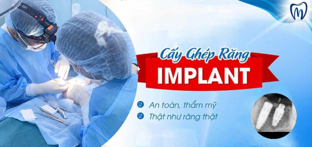 cắm trụ implant