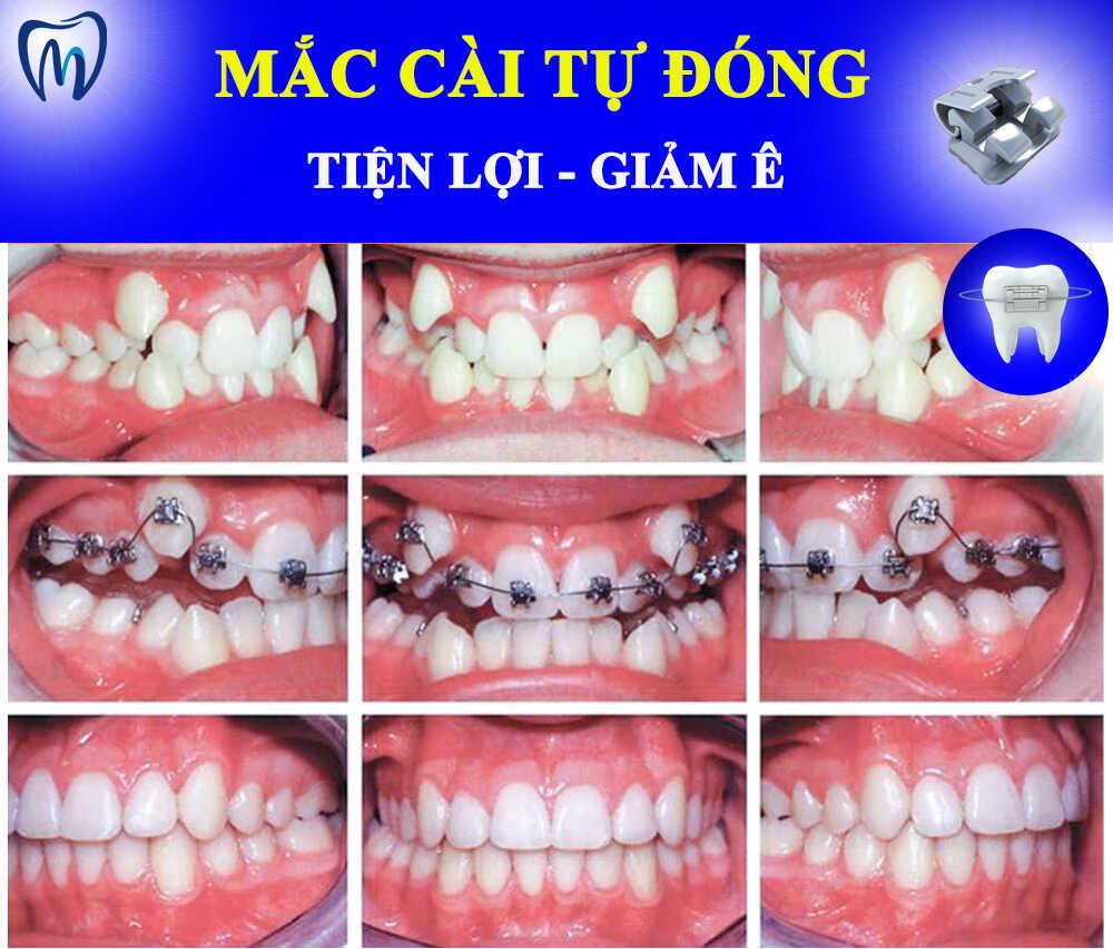 NIỀNG RĂNG MẮC CÀI TỰ ĐÓNG