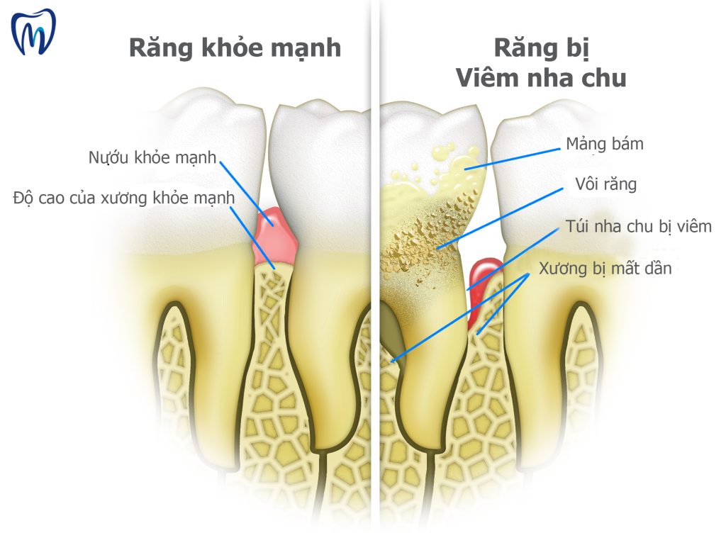 Răng viêm tuỷ