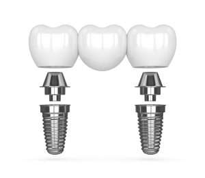 Điều kiện bảo hành dịch vụ Implant
