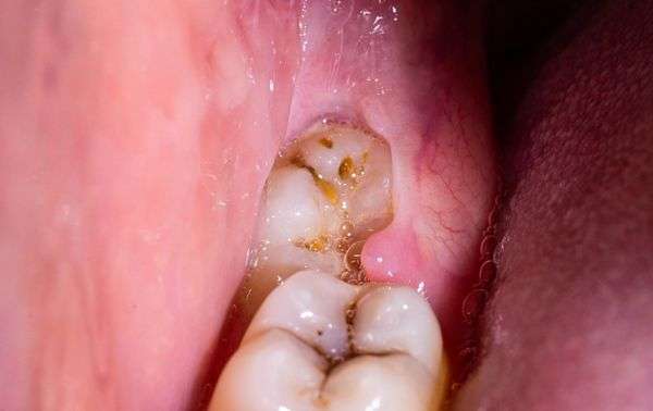 viêm nướu trùm răng khôn