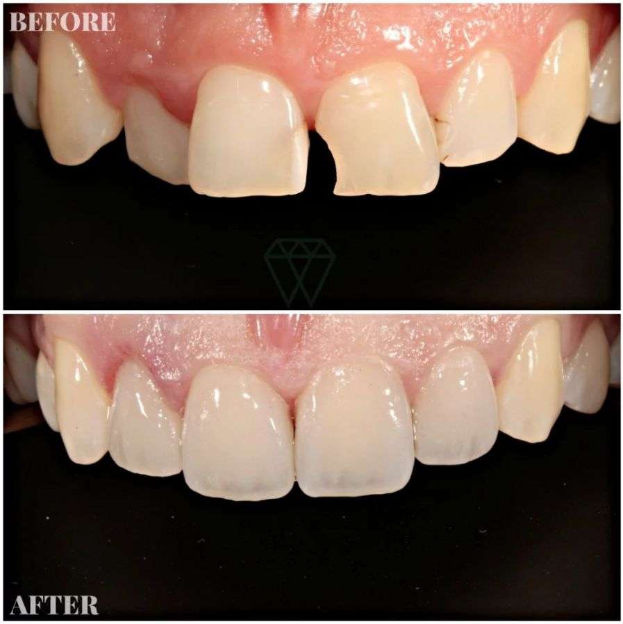 răng mẻ bọc răng sứ thẩm mỹ