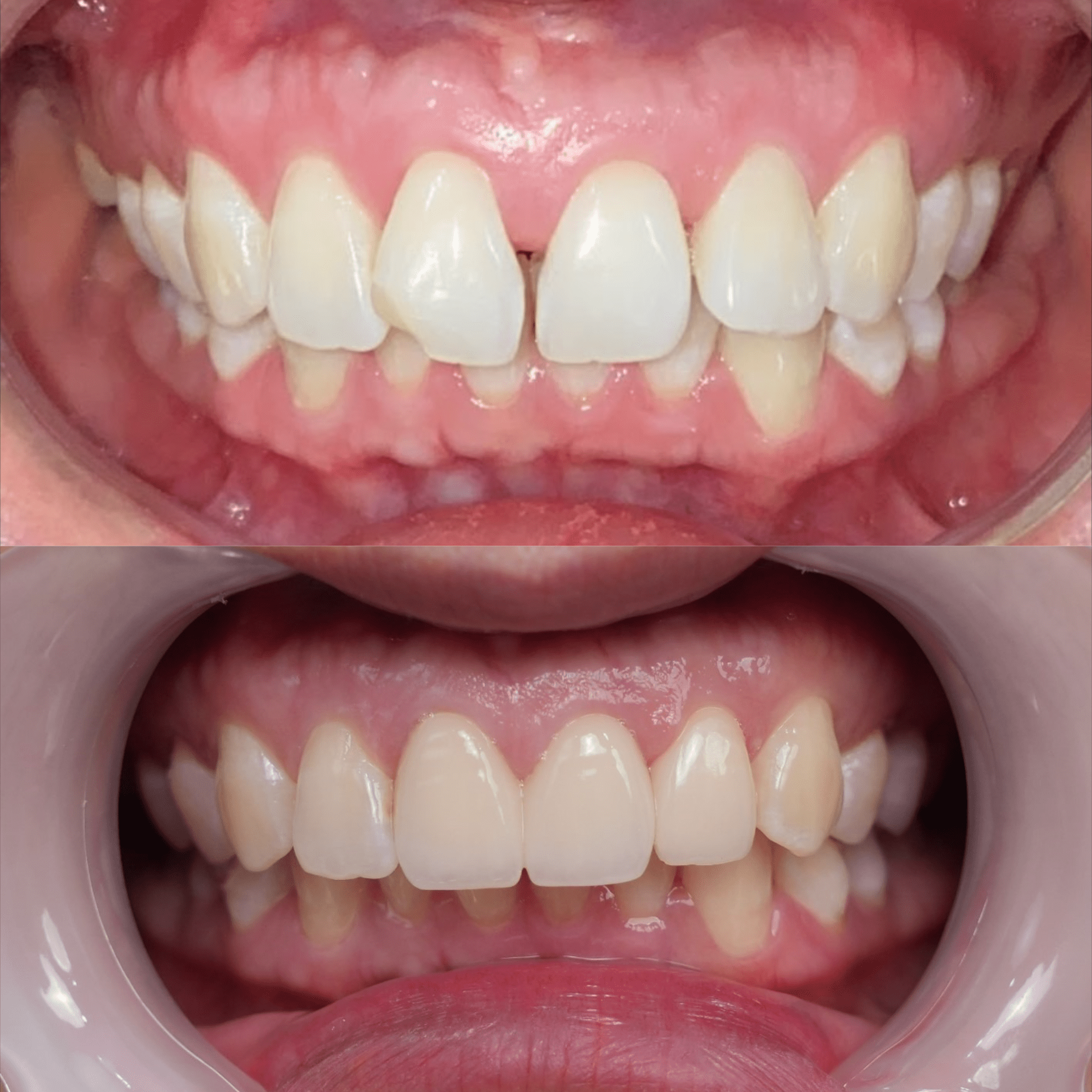 răng thưa bọc răng sứ thẩm mỹ