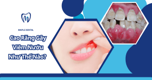 Cao Răng Gây Viêm Nướu Như Thế Nào? Dấu Hiệu Và Cách Xử Lý