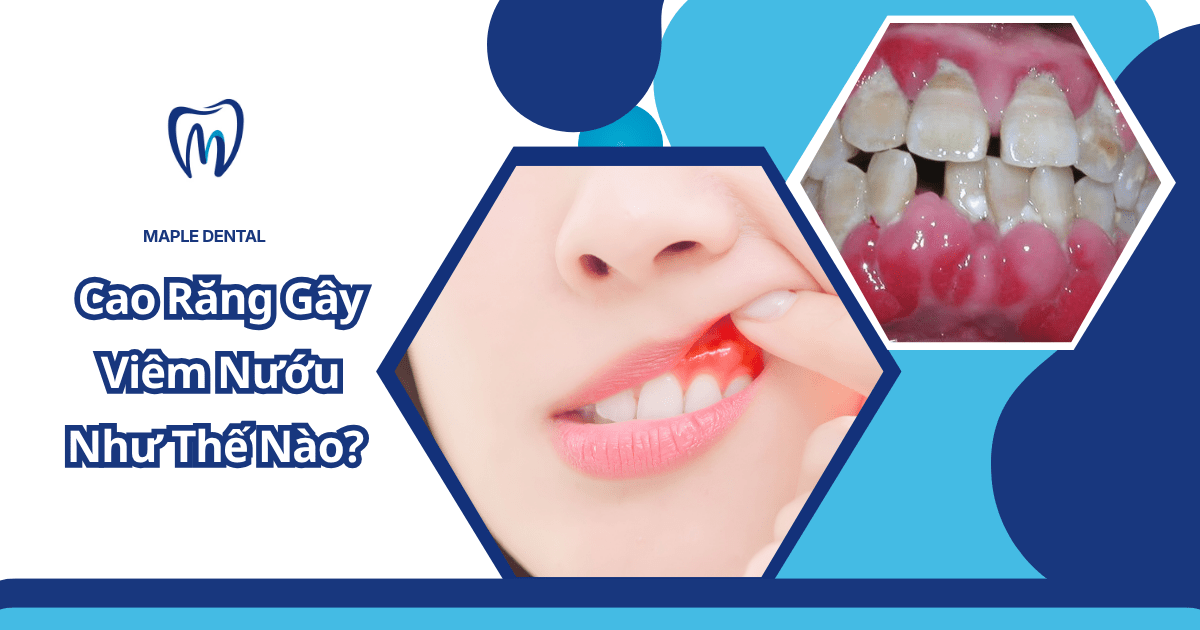 viêm nướu