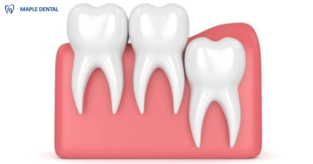 Răng khôn mọc đúng hướng